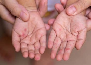 Tragedi Medis 2026: Mengapa Campak Masih Mengancam Nyawa Dokter Muda di Cianjur?